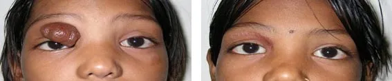 Eyelid and Skin Cancer Reconstruction